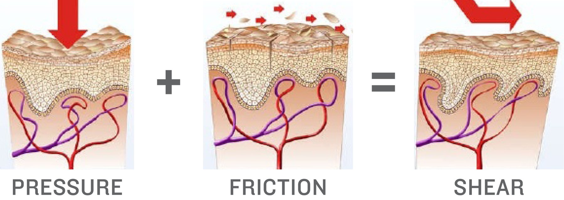 Foto zu Shear reduction: An important element in pressure injury prevention 
